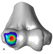 Osteochondritis