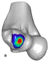 Osteochondritis
