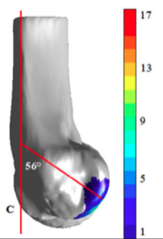 Osteochondritis