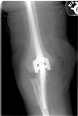 arthritis-xray