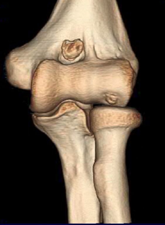 Osteochondritis