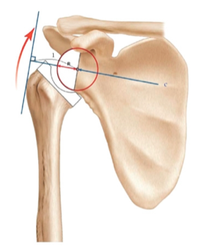 hemiarthroplasty