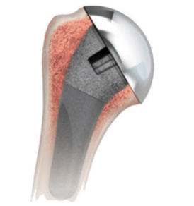 hemiarthroplasty