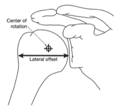 hemiarthroplasty